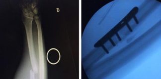 Estado del hueso antes y después de la operación @raultato