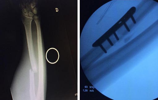 Estado del hueso antes y después de la operación @raultato