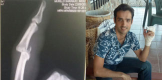 Radigrafía de la fractura del dedo, a pesar de ellos Miguelín toreó en Alburquerque y Monroy