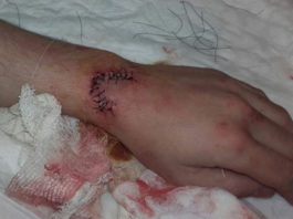 Aspecto de la muñeca del novillero Antonio Medina tras ser suturada la herida