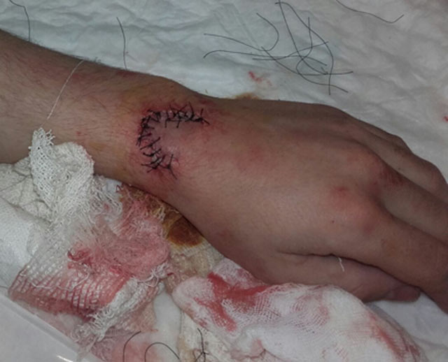Aspecto de la muñeca del novillero Antonio Medina tras ser suturada la herida
